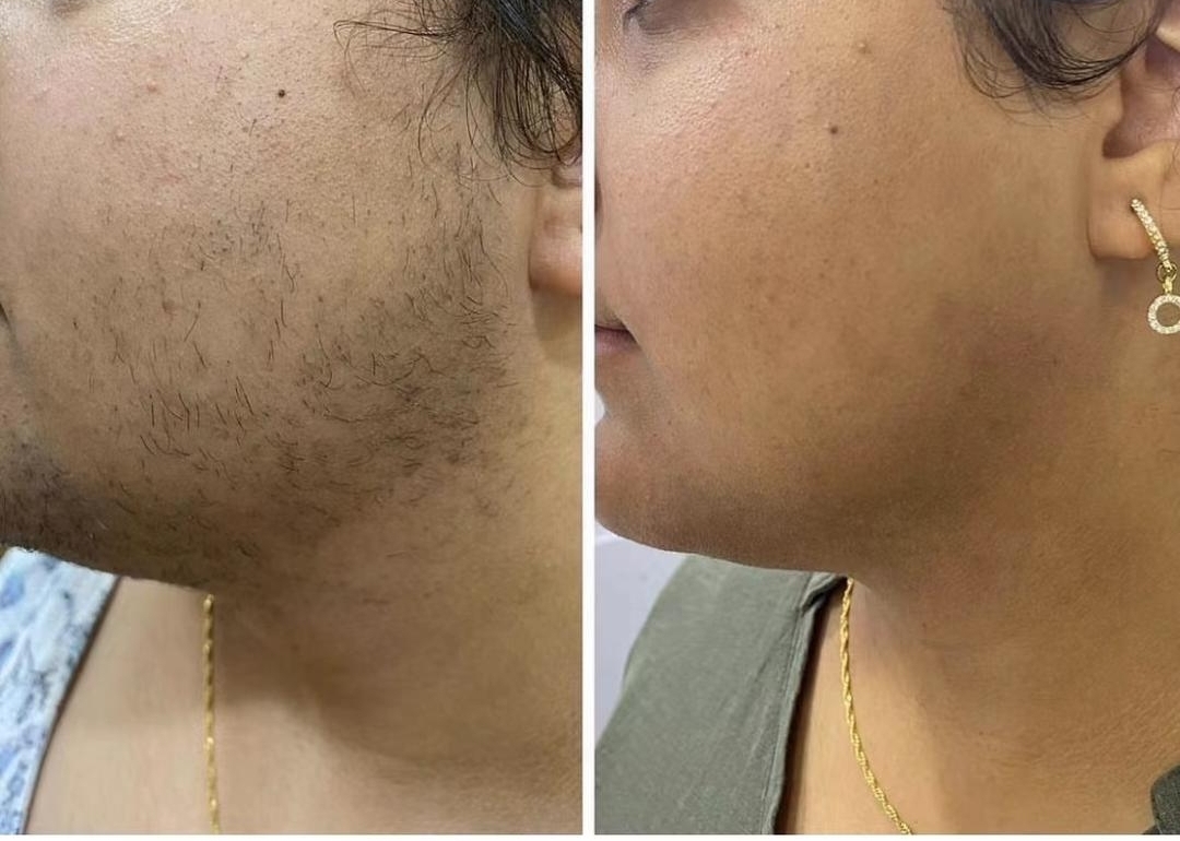 Small Area Laser Hair Removal - Before & After